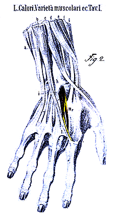 Image of doubled extensor digiti medii