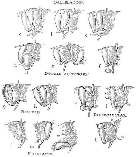 Types of Gallbladder