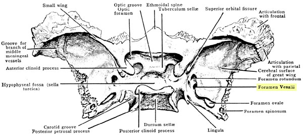 First described by Andreas Vesalius, this rare foramen in thesphenoid