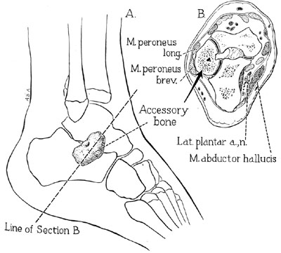 The accessory tarsal bones were so well described by Pfitzner in1986