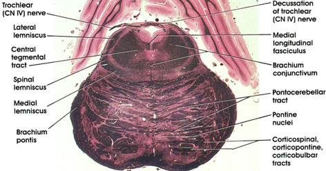 Plate 17.337 Pons- Mesencephalic Junction