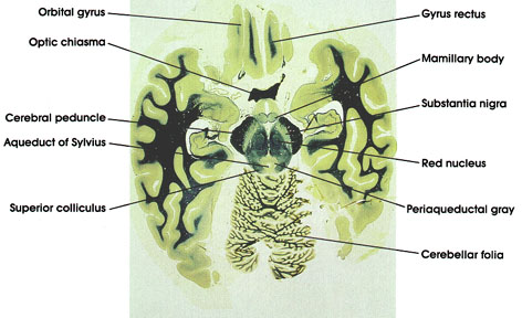 Plate 17.356 Mesencephalon-Diencephalon Junction