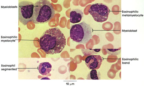 myelocyte and metamyelocyte