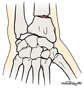 Colle's fracture