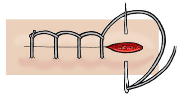 Running Locking Stitch