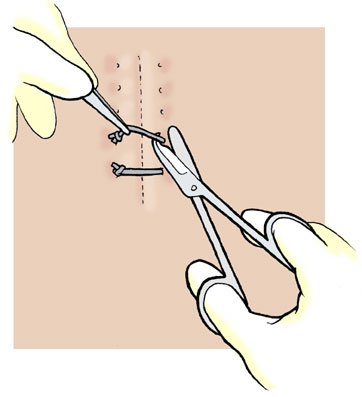 remove stitches